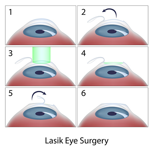 LASIK eye surgery image process