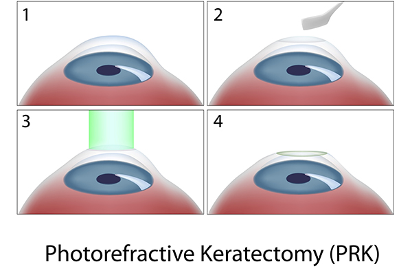 visual guide to a photorefractive kertectomy (prk)